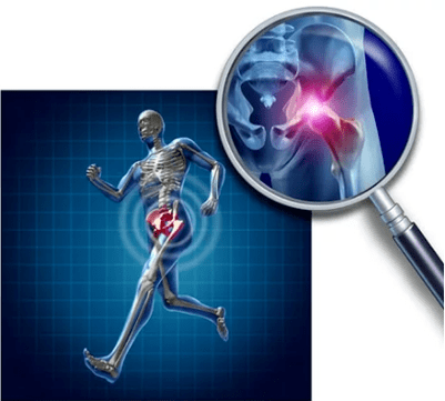 Arthrose van de heupgewrichten