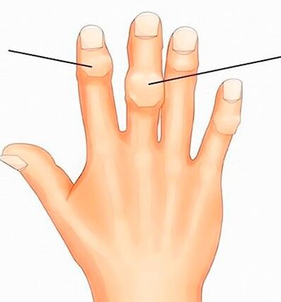 Knooppunten van Heberden en Bouchard op de interfalangeale gewrichten met artrose