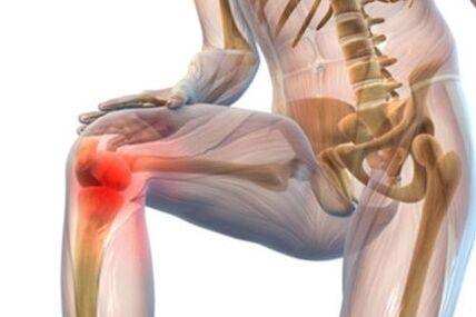 Arthrose van het kniegewricht
