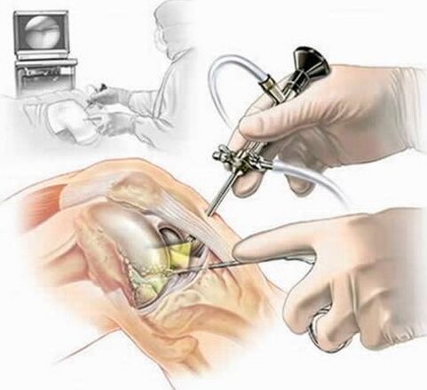 Werking op het kniegewricht - Arthroscopie