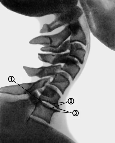 Röntgenfoto van de cervicale wervelkolom met osteochondrose