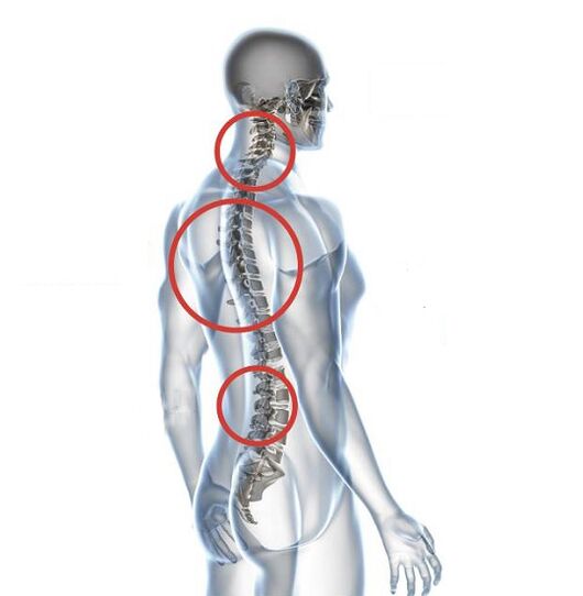 Hoe manifesteert osteochondrose zich