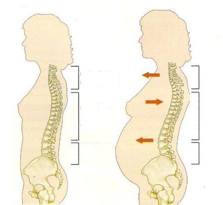 osteochondrose tijdens de zwangerschap