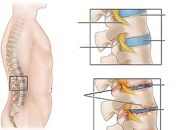 veranderingen in schijven als gevolg van osteochondrose